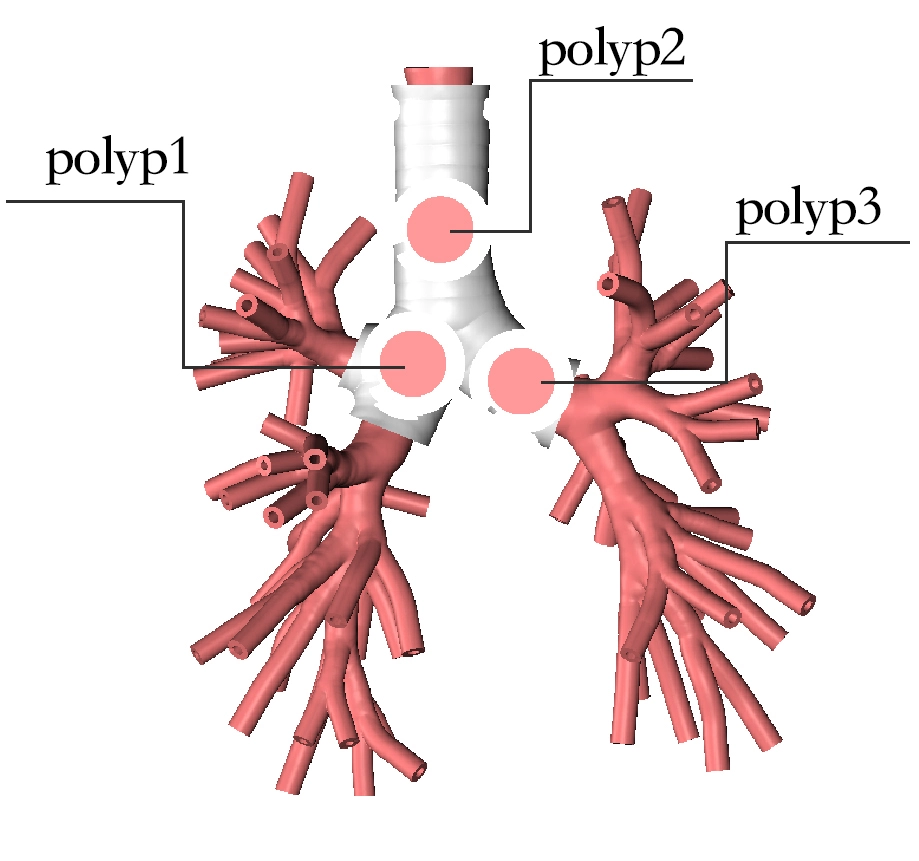 location of bronchial lesions